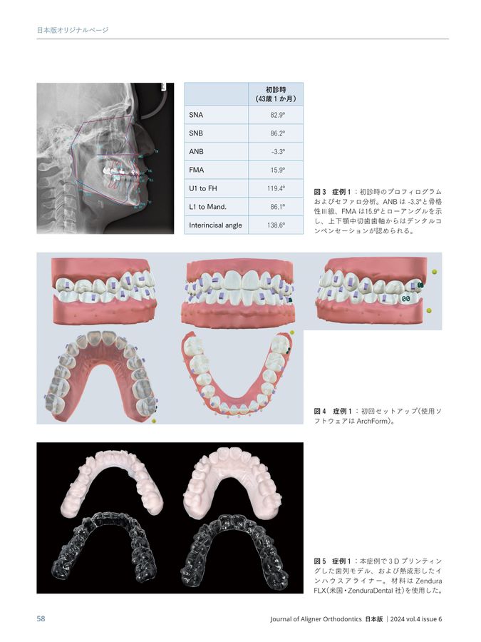 JAO［Journal of Aligner Orthodontics］日本版 2024年No.6