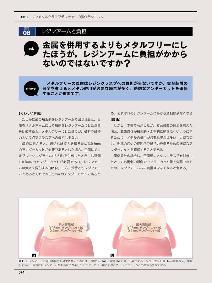 ノンメタルクラスプデンチャー 増補新版