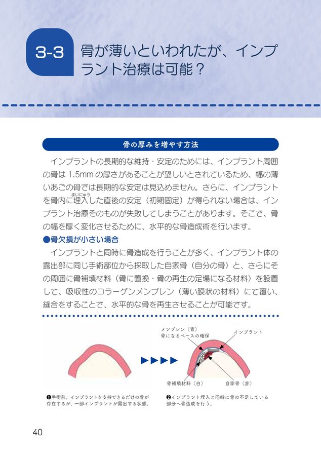 Q&Aでわかる インプラント治療ガイド2