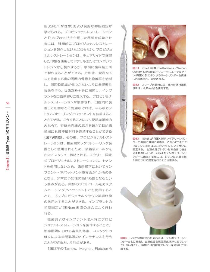 シングル・トゥースインプラント