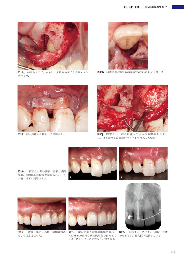 5-Dコンセンサス 歯の保存にこだわる
