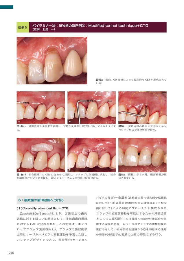 5-Dコンセンサス 歯の保存にこだわる
