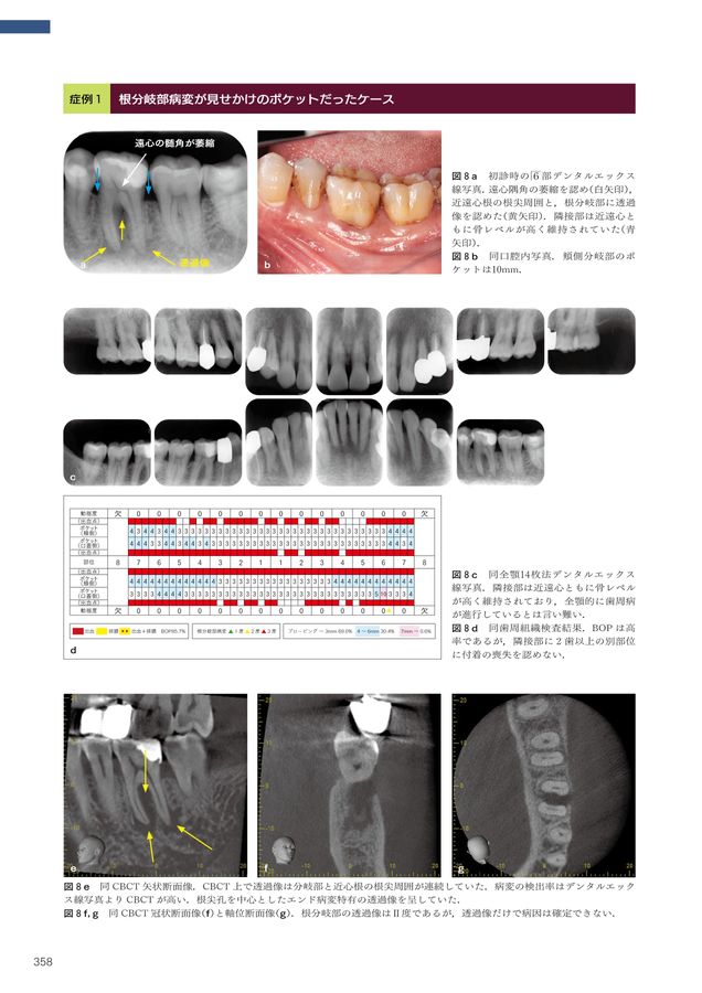 5-Dコンセンサス 歯の保存にこだわる