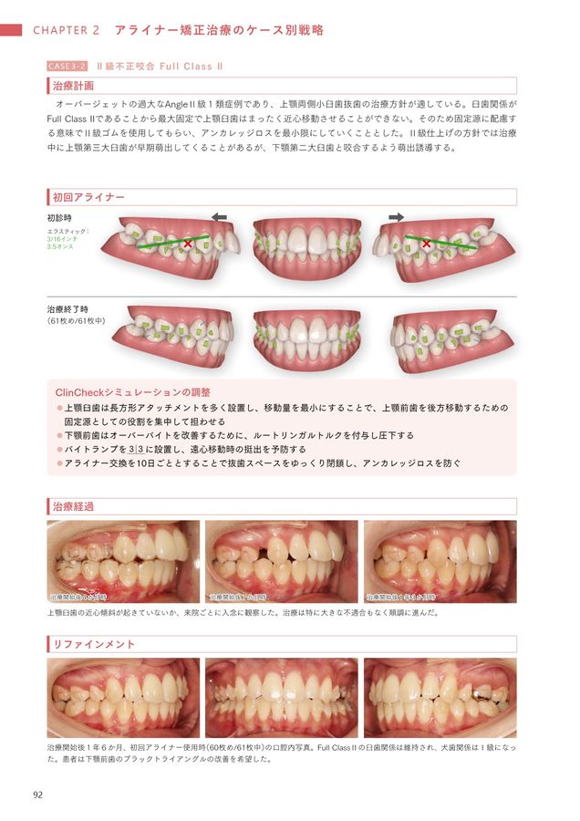 アライナー矯正治療 　 診断/治療計画/矯正治療/顎位整復治療 Amazon.co.jp: アライナー矯正治療 診断/治療計画/矯正治療/顎位