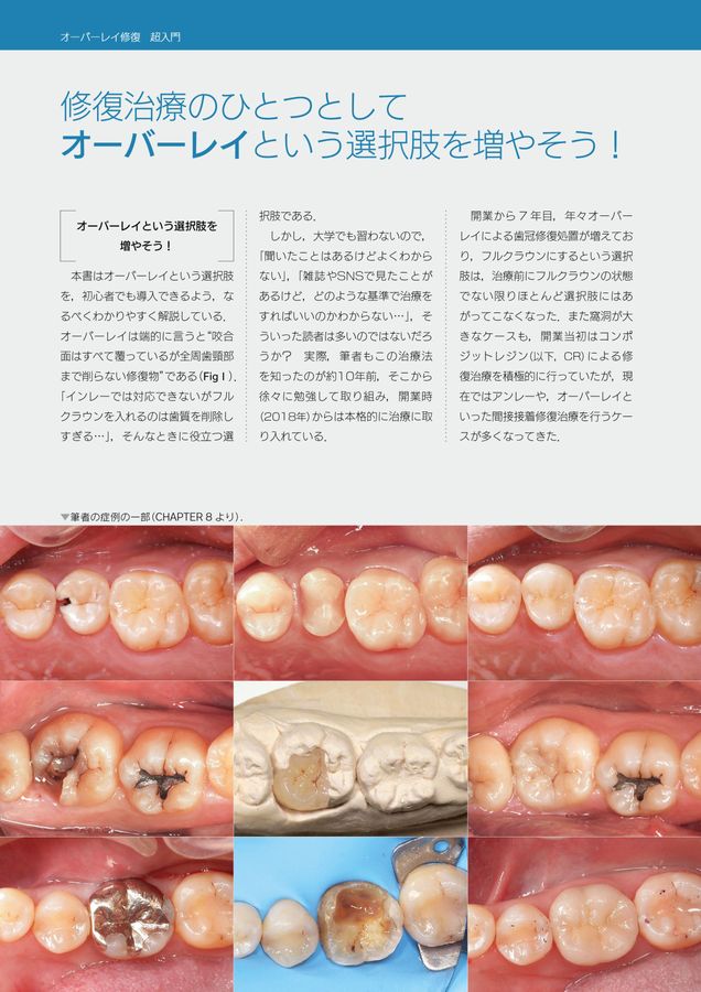 オーバーレイ修復超入門※裁断済 オーバーレイ修復 超入門 | 辻本真規 |本 | 通販 | Amazon