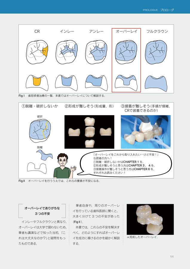 オーバーレイ修復 超入門