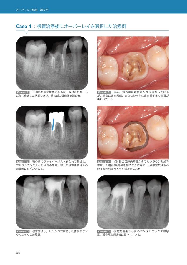 オーバーレイ修復 超入門