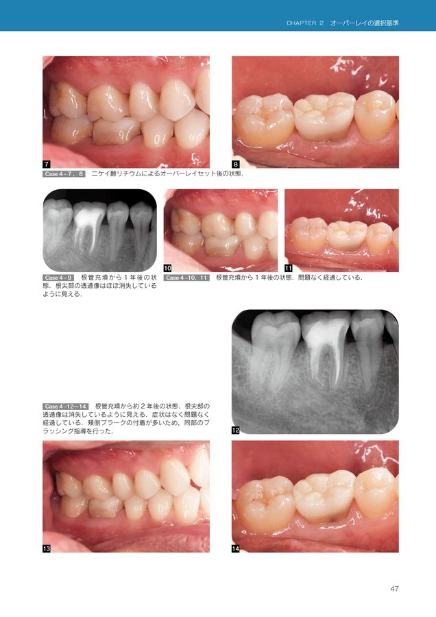オーバーレイ修復 超入門