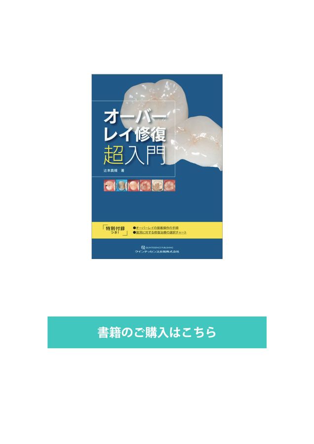 オーバーレイ修復 超入門