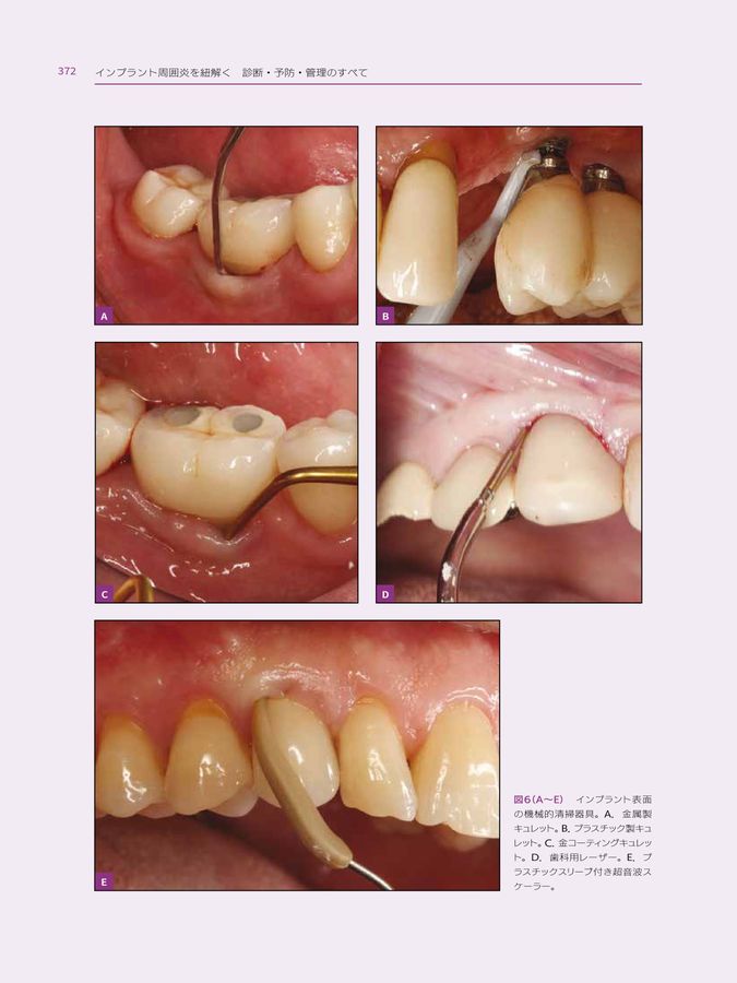 インプラント周囲炎を紐解く