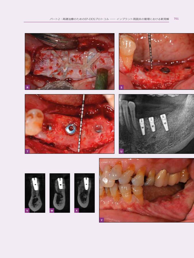 インプラント周囲炎を紐解く