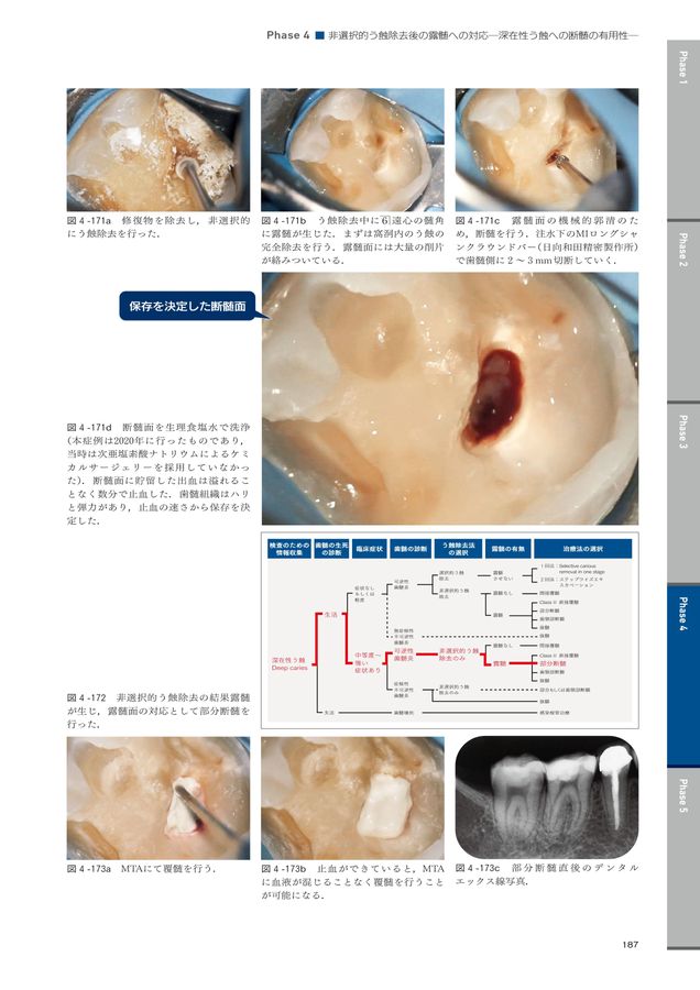 ⚠裁断済　深在性う蝕に対するVital Pulp Therapy　☆ 裁断済]深在性う蝕に対するVital Pulp Therapy 健康・医学