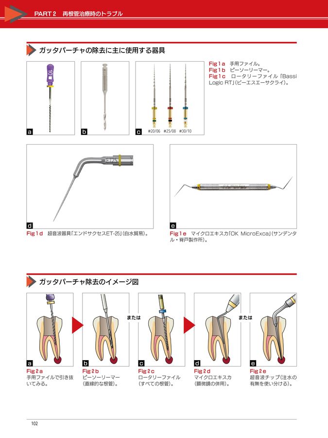 完全解説 根管治療トラブル攻略本