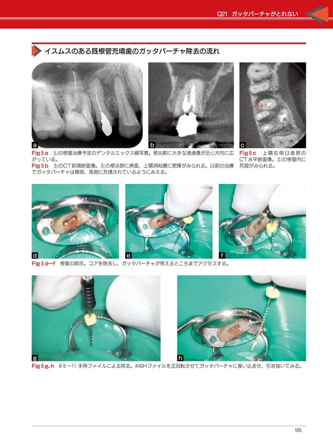 完全解説 根管治療トラブル攻略本