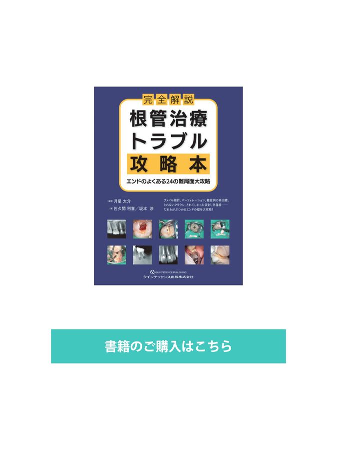 完全解説 根管治療トラブル攻略本