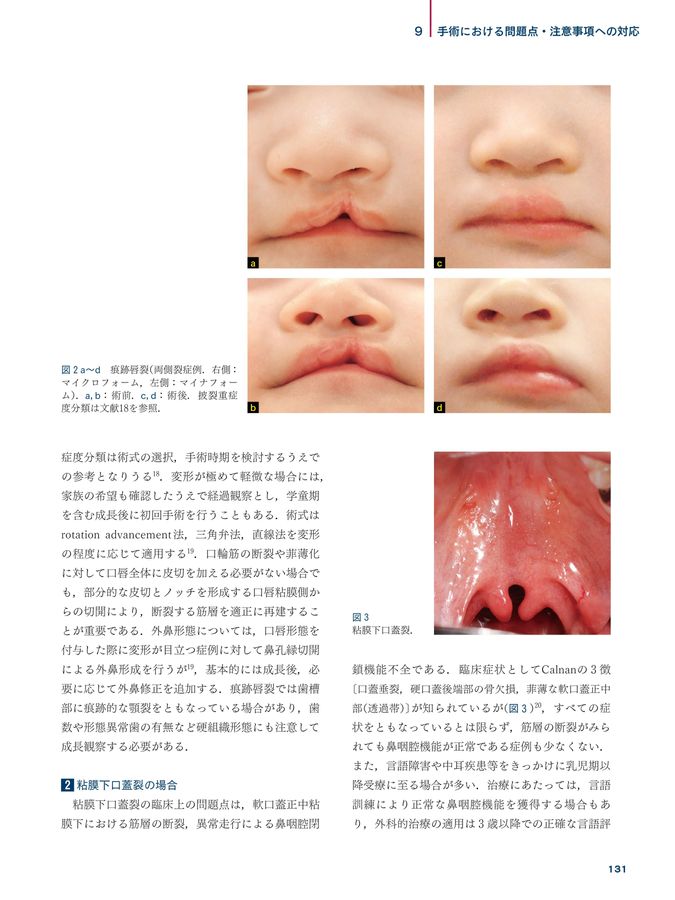 口唇裂・口蓋裂治療