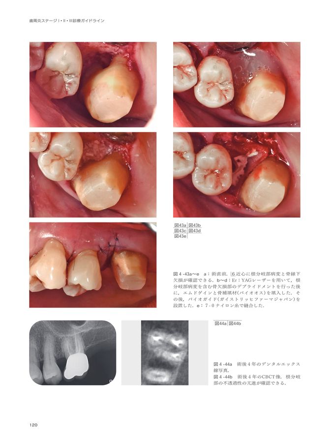 歯周炎ステージⅠ・Ⅱ・Ⅲ診療ガイドライン