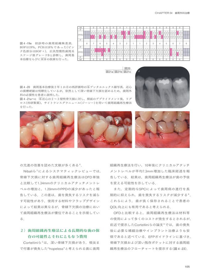 歯周炎ステージⅠ・Ⅱ・Ⅲ診療ガイドライン