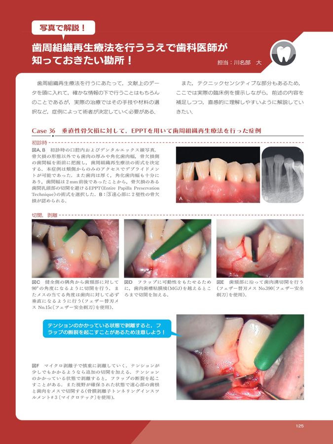 歯周炎ステージⅠ・Ⅱ・Ⅲ診療ガイドライン