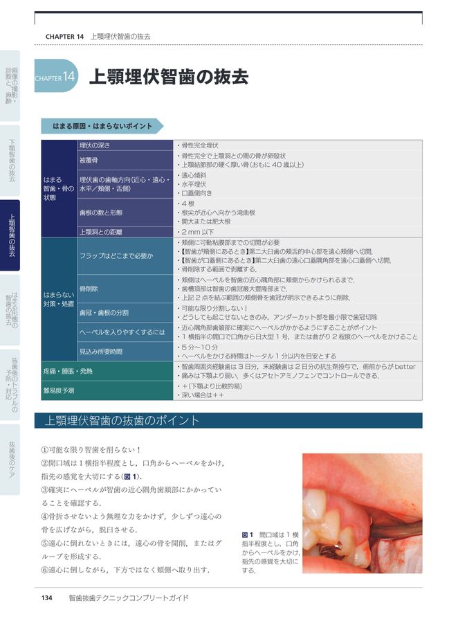 智歯抜歯テクニックコンプリートガイド はまる原因，はまらない対策と処置 智歯抜歯テクニックコンプリートガイド: はまる原因、はまらない対策と