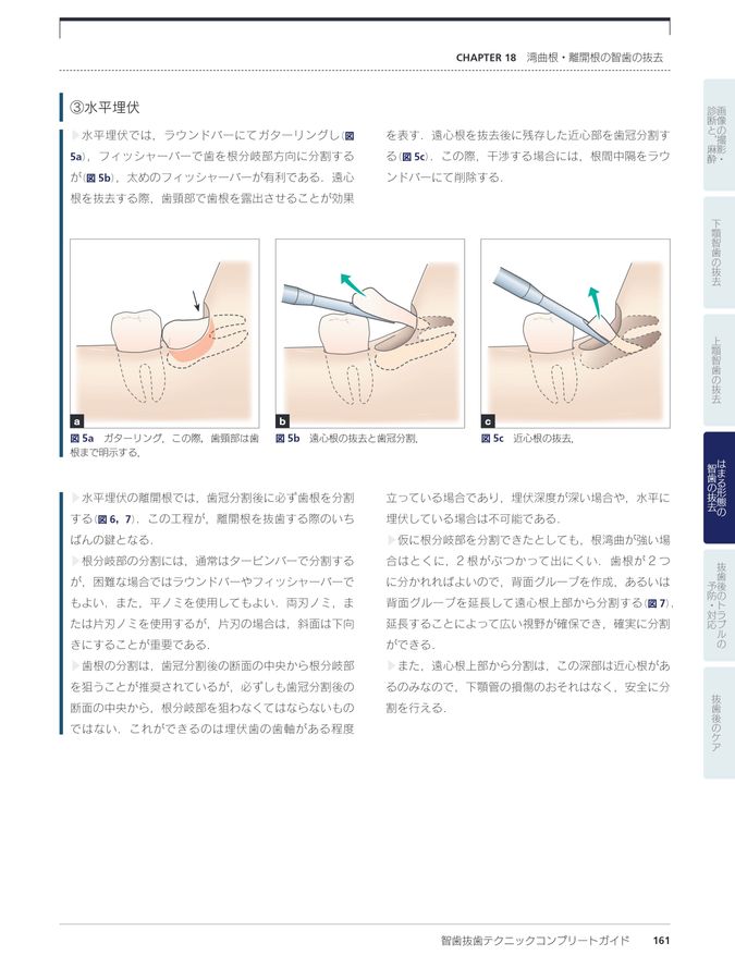 智歯抜歯テクニックコンプリートガイド
