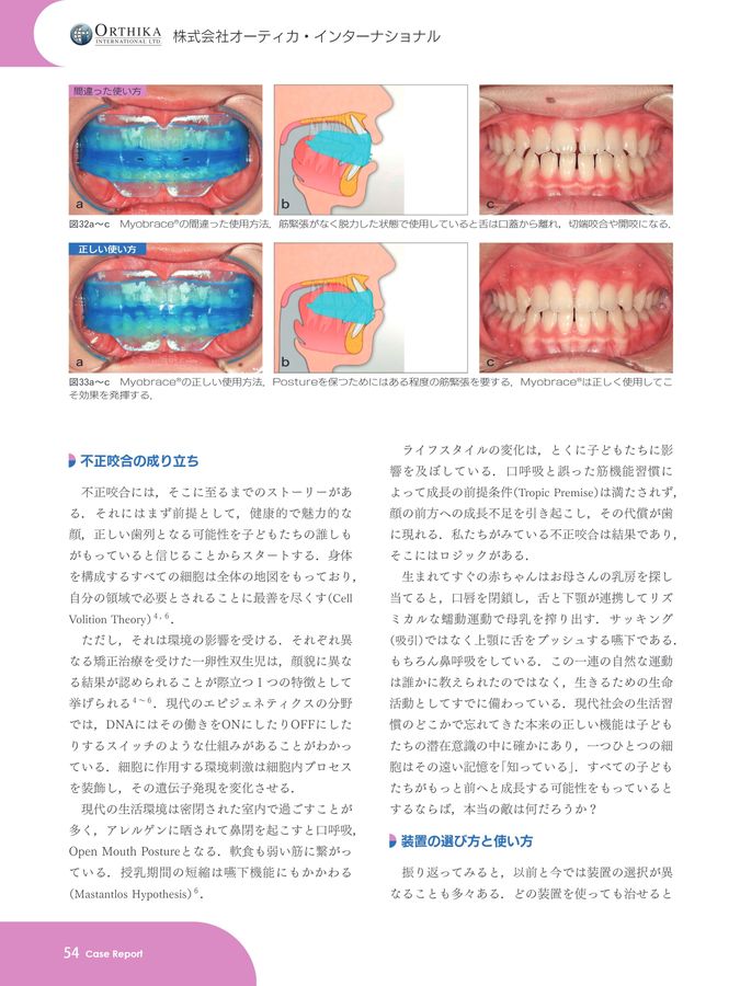 子どものための機能的マウスピース矯正装置