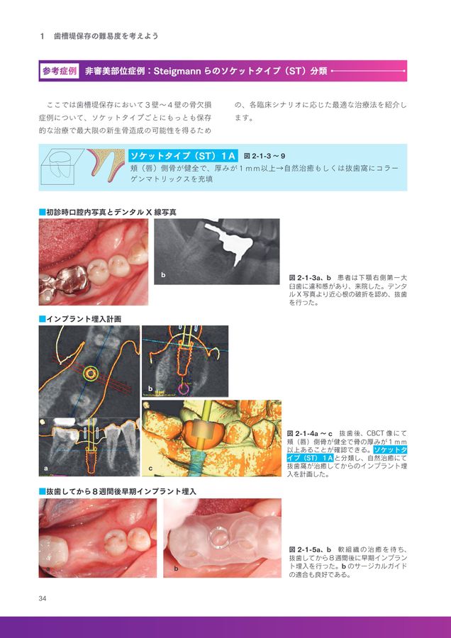 ベーシック歯槽堤保存
