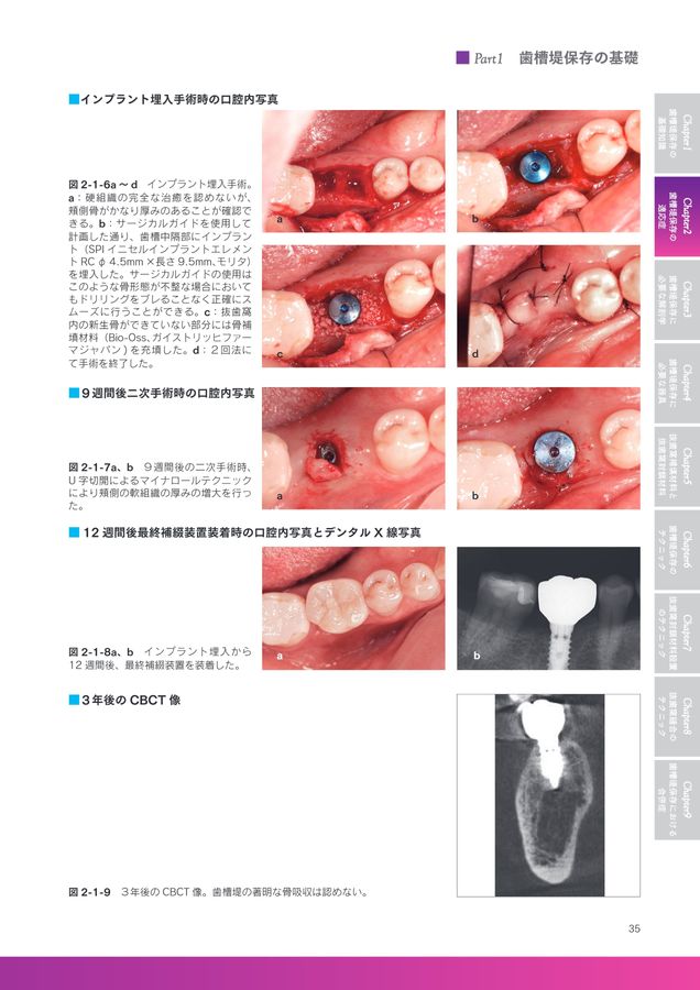 【裁断済み】ベーシック 歯槽堤保存 ベーシック歯槽堤保存