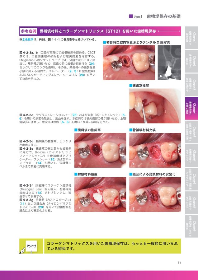 ベーシック歯槽堤保存