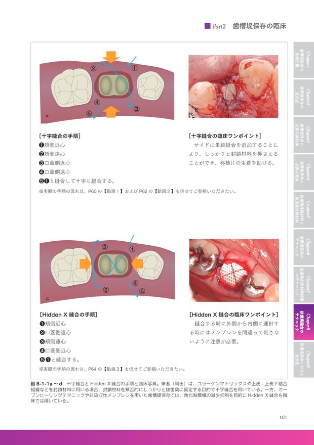ベーシック歯槽堤保存