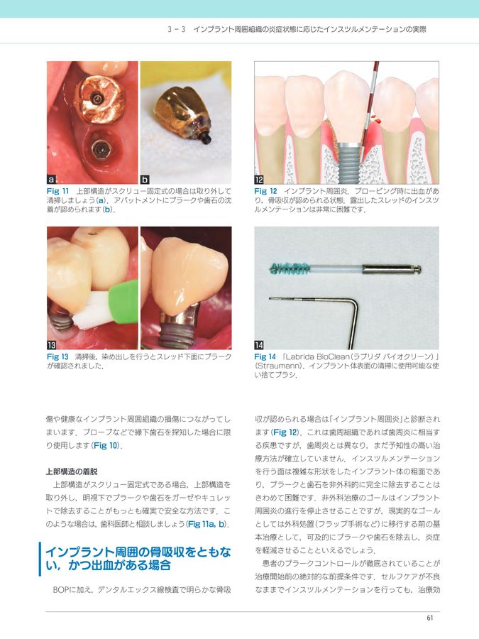 【４月新刊】そこが知りたいDr.とDHのためのインプラントのメインテナンス　歯科 そこが知りたい！ Dr.とDHのためのインプラントのメインテナンス