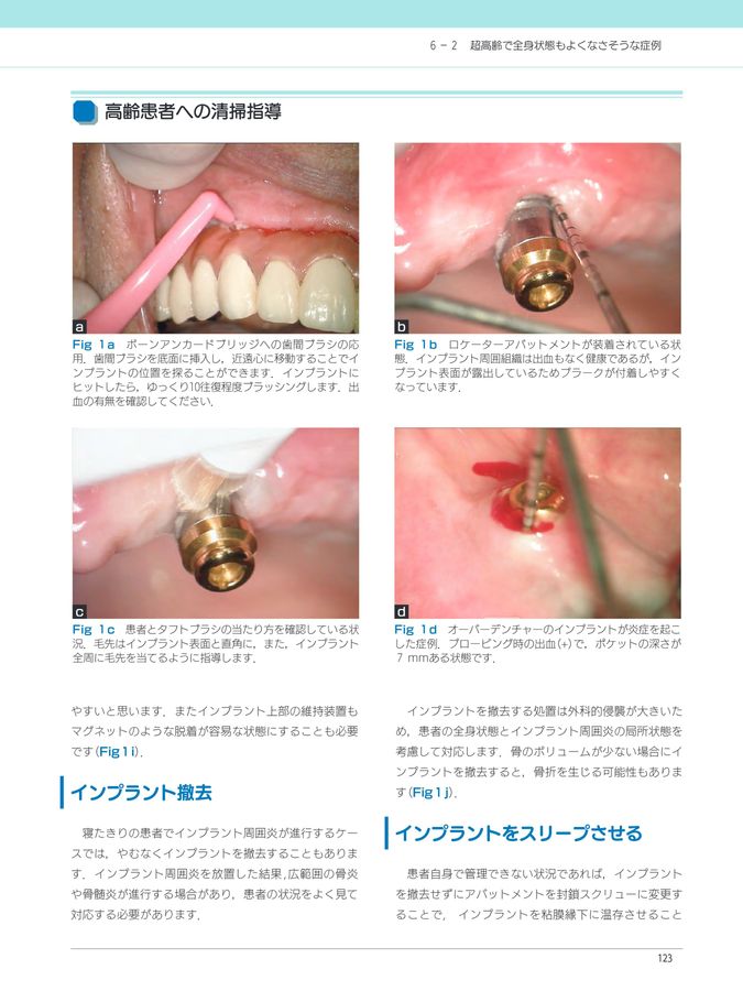【４月新刊】そこが知りたいDr.とDHのためのインプラントのメインテナンス　歯科 そこが知りたい！ Dr.とDHのためのインプラントのメインテナンス