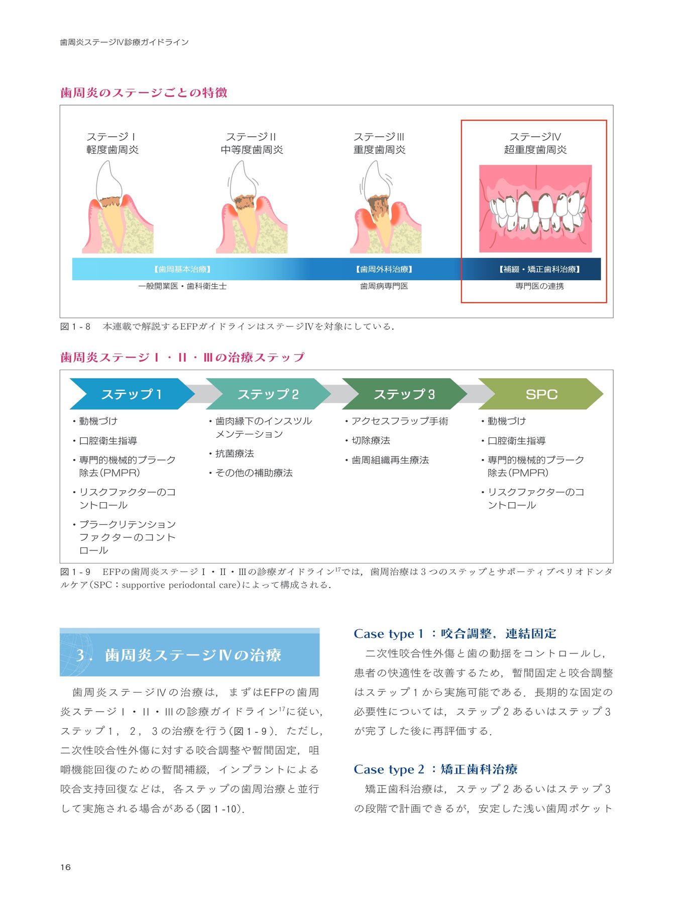 【裁断済】 歯周炎ステージ1・2・3診療ガイドライン : Q&Aで紐解く! 歯周炎ステージⅣ診療ガイドライン