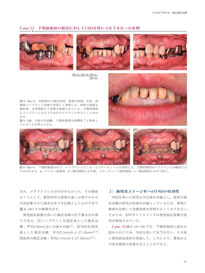 歯周炎ステージⅣ診療ガイドライン
