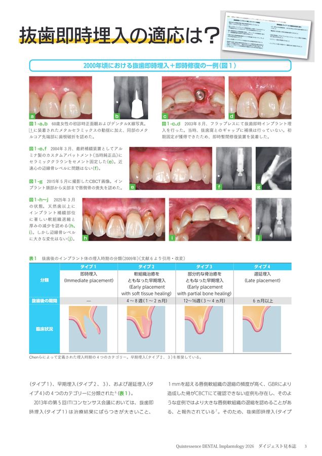Quintessence DENTAL Implantologyダイジェスト 見本誌2026